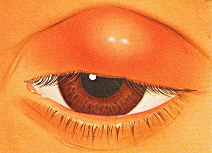 Шишка на верхньому або нижньому столітті очі - причини і лікування