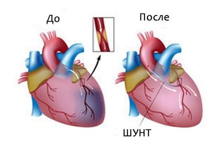 Vasculare de manevră