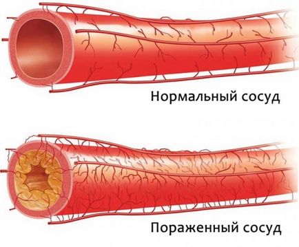 Vasculare de manevră