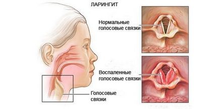 Simptomele și tratamentul laringitei la adulți