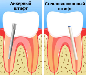 Скільки коштує наростити зуб, поставити коронку, як нарощують передні зуби