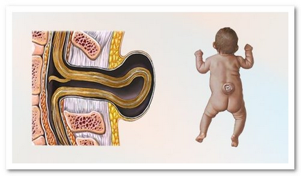 Simptomele herniei spinale, tratamentul, pericolele, consecințele