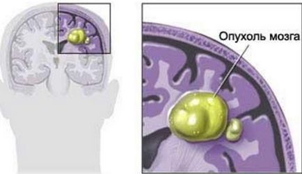 Herniile cerebrospinale (disc herniated), tratamentul în Israel