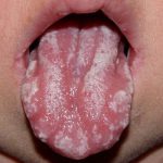 Стоматит мовою у дитини причини появи і лікування