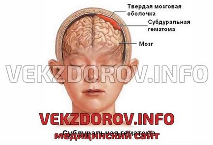 Afecțiuni hemoragice cauzate de subdural, clinică și prognostic