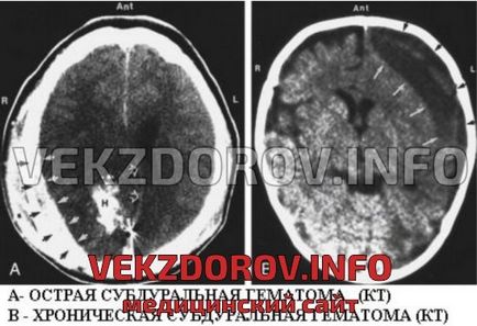 Afecțiuni hemoragice cauzate de subdural, clinică și prognostic