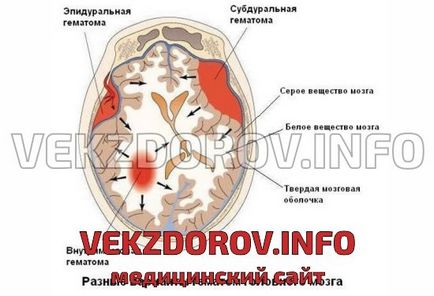 Afecțiuni hemoragice cauzate de subdural, clinică și prognostic