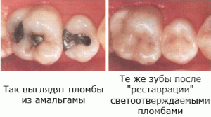 Світлові пломби на передні зуби