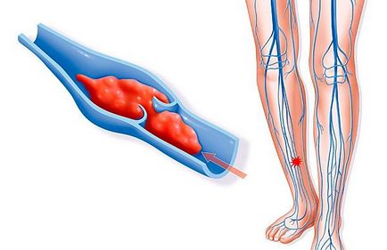 Тромбофлебіт глибоких вен нижніх кінцівок - симптоми лікування і профілактика