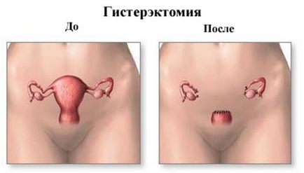 Îndepărtarea tuburilor uterine sau uterine, consecințe și complicații