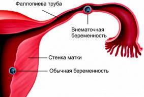 Îndepărtarea tuburilor uterine sau uterine, consecințe și complicații