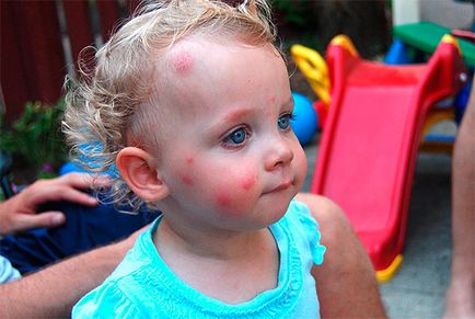 Bite de copii mici bugbugs au muscat bug-uri