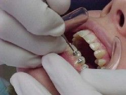 Послуги ортодонта в Тюмені ціни на брекети, ортодонтія в стоматології, скільки коштують поставити скоби