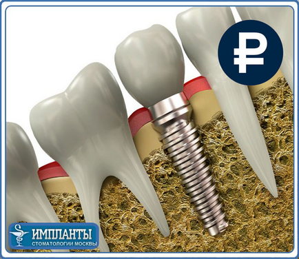 Instalarea implantului în rădăcina dintelui este calitativ - proteza implantului în rădăcină în mod inexpensiv