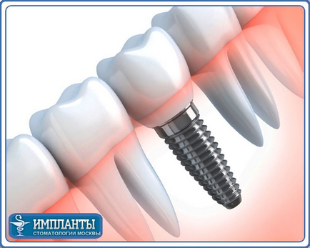 Установка імпланта в корінь зуба якісно - протезування імплантату в корінь недорого