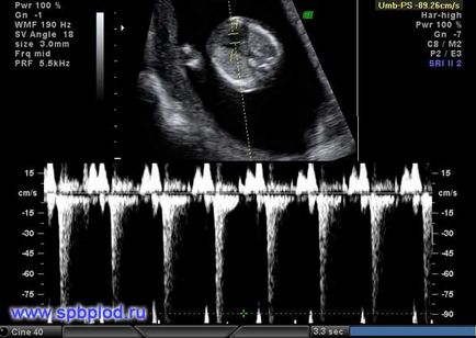 Uzi în 11 12 13 săptămâni cu sarcină prima fotografie uzi fotografie în Sankt Petersburg, centrul de medicina fetală