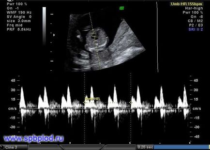 Uzi în 11 12 13 săptămâni cu sarcină prima fotografie uzi fotografie în Sankt Petersburg, centrul de medicina fetală
