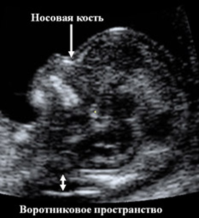 Узі в 11 12 13 тижнів при вагітності перше УЗД фото відео в Харків, центр медицини плода