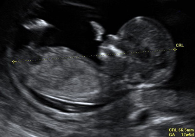 Uzi în 11 12 13 săptămâni cu sarcină prima fotografie uzi fotografie în Sankt Petersburg, centrul de medicina fetală