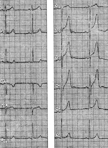 Opțiuni pentru o electrocardiogramă normală