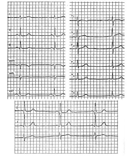 Opțiuni pentru o electrocardiogramă normală
