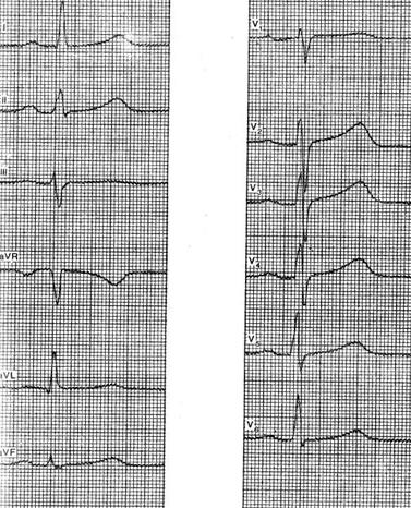 Opțiuni pentru o electrocardiogramă normală