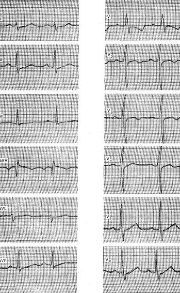 Opțiuni pentru o electrocardiogramă normală