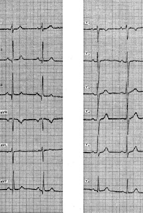 Opțiuni pentru o electrocardiogramă normală