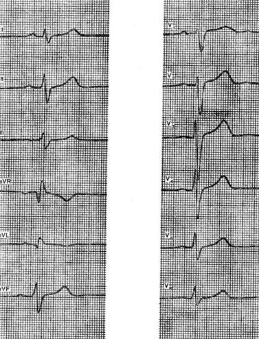 Opțiuni pentru o electrocardiogramă normală