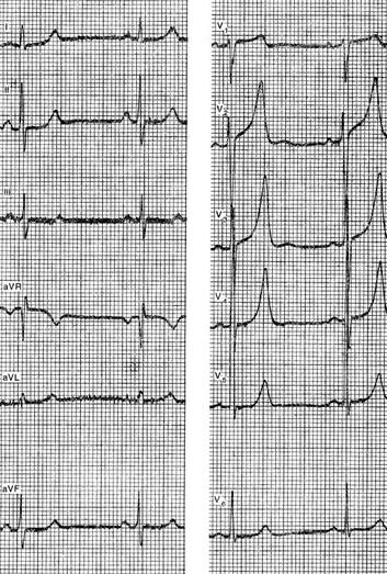 Opțiuni pentru o electrocardiogramă normală