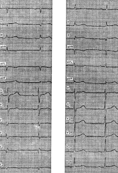 Opțiuni pentru o electrocardiogramă normală