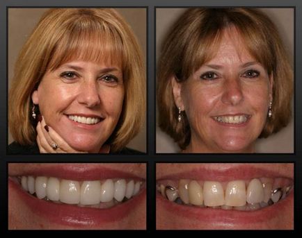 Întoarceți-vă un zâmbet frumos va ajuta protezele permanente ale dinților