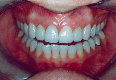 Повернути гарну посмішку допоможе незнімне протезування зубів