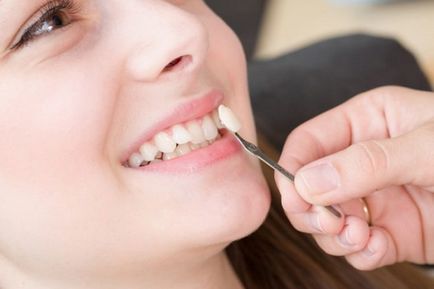 Ferestrele fără pregătire dentară pot fi instalate întotdeauna