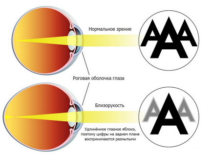 Vitaminele și picăturile de ochi pentru miopie pentru a îmbunătăți vederea