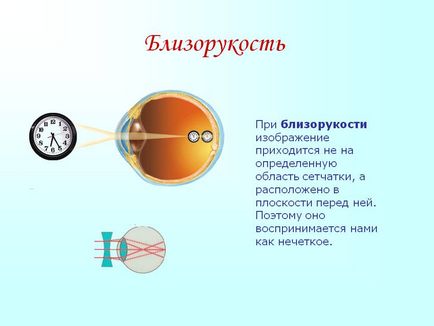 Vitaminok és szemcseppek myopia hogy javítsa a látást