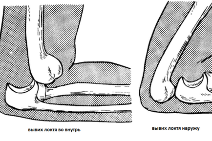 Dislocarea articulației cotului, recuperare, tratament, exerciții