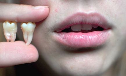 Можливі ускладнення після видалення зуба, зубів