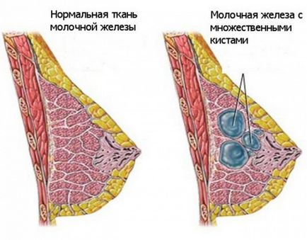 Печіння в грудній залозі огляд причин