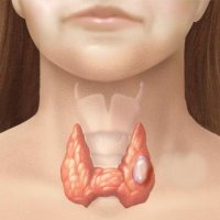 Adenomul tiroidian - bisturiu - informație medicală și portal educațional