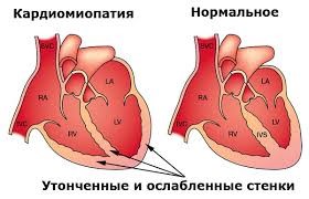 Алкоголь і серце шкоду впливу напоїв для нього і наслідки навантаження, болі, важкість