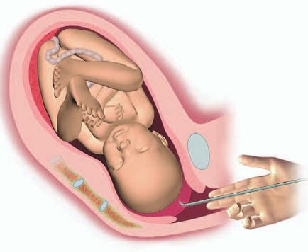 Amniotomie - puncția lichidului amniotic înainte de naștere, ideală pentru mine