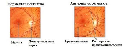 Angiopatia retinei la copii