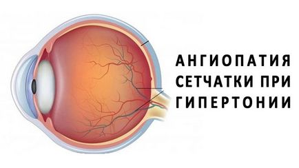 Angiopathy a retina egy gyermek szemébe - mi ez