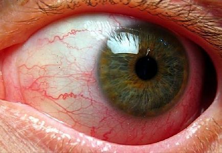 Angiopathy a retina a gyermek és az újszülött - mi ez
