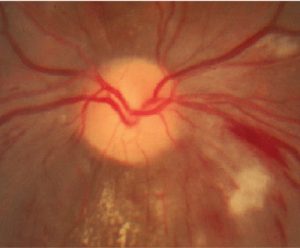 Angiopatia retinei tratamentului ocular, simptomatologie