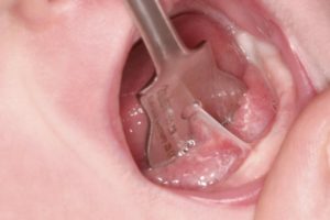 Ankyloglossia - jelek, tünetek, kezelés, rövid kantár