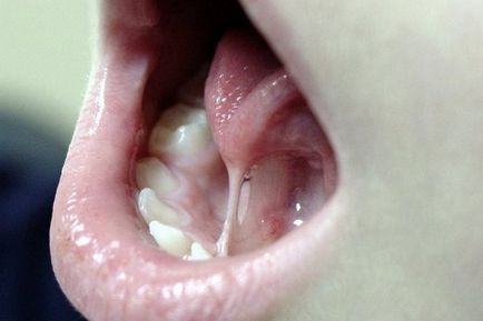 Ankyloglossia - jelek, tünetek, kezelés, rövid kantár