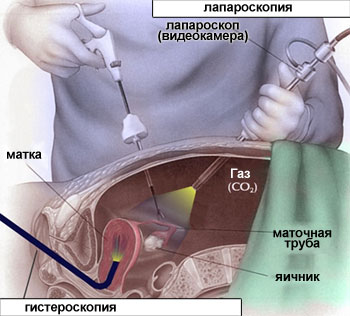 Вагітність після лапароскопії