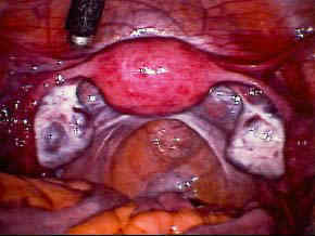 Terhesség után laparoszkópia